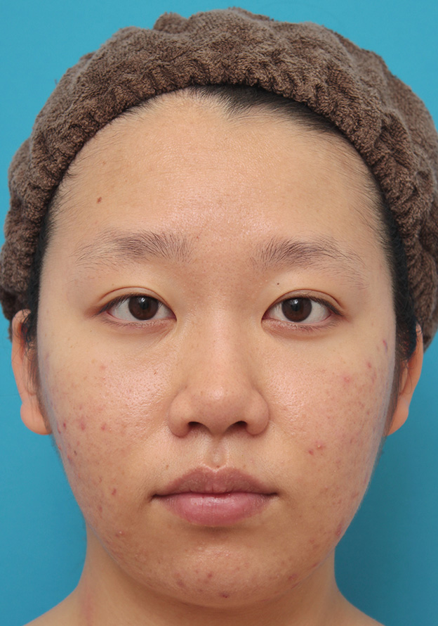 症例写真,小鼻（鼻翼）縮小手術で鼻の穴の内側から外側の途中にかけて切除した症例写真,1週間後,mainpic_biyoku039c.jpg