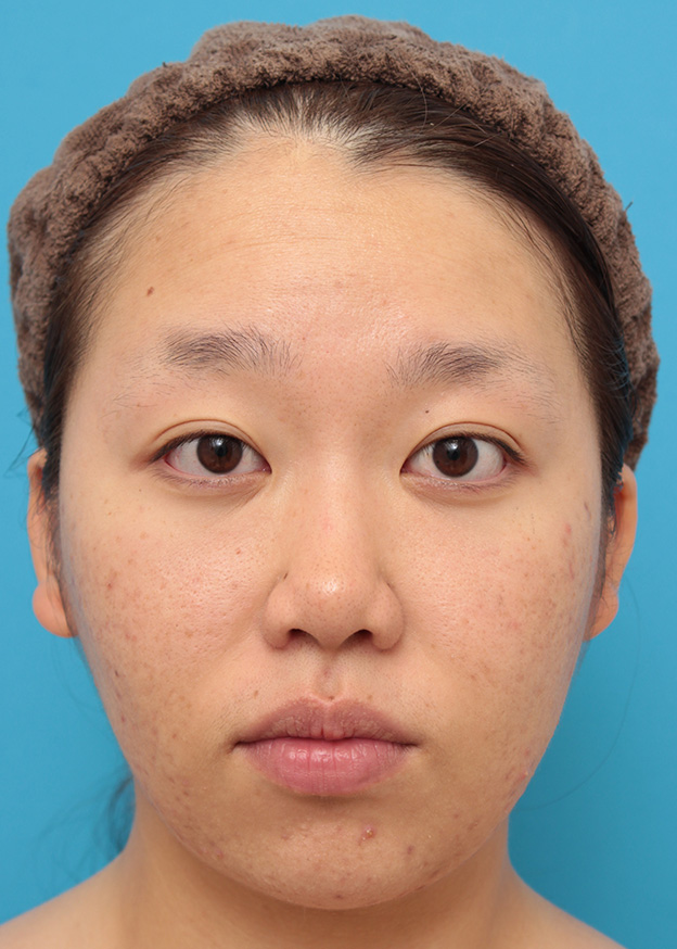 症例写真,小鼻（鼻翼）縮小手術で鼻の穴の内側から外側の途中にかけて切除した症例写真,8ヶ月後,mainpic_biyoku039d.jpg