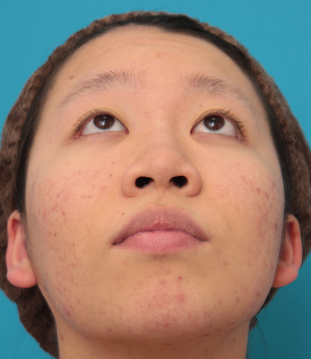症例写真,小鼻（鼻翼）縮小手術で鼻の穴の内側から外側の途中にかけて切除した症例写真,手術前,mainpic_biyoku039e.jpg