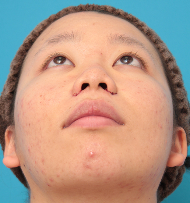 症例写真,小鼻（鼻翼）縮小手術で鼻の穴の内側から外側の途中にかけて切除した症例写真,手術直後,mainpic_biyoku039f.jpg