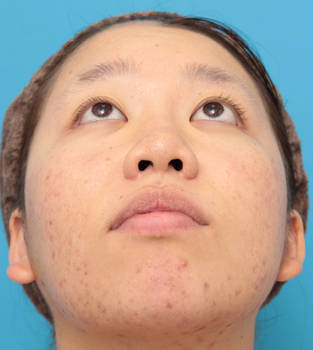 症例写真,小鼻（鼻翼）縮小手術で鼻の穴の内側から外側の途中にかけて切除した症例写真,8ヶ月後,mainpic_biyoku039h.jpg