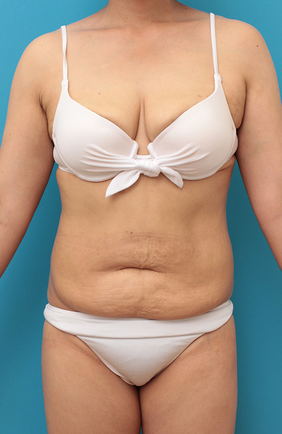 症例写真,お腹のたるみ取り手術（腹部リダクション）の腫れが引いていく症例写真,Before,ba_hara001_b01.jpg