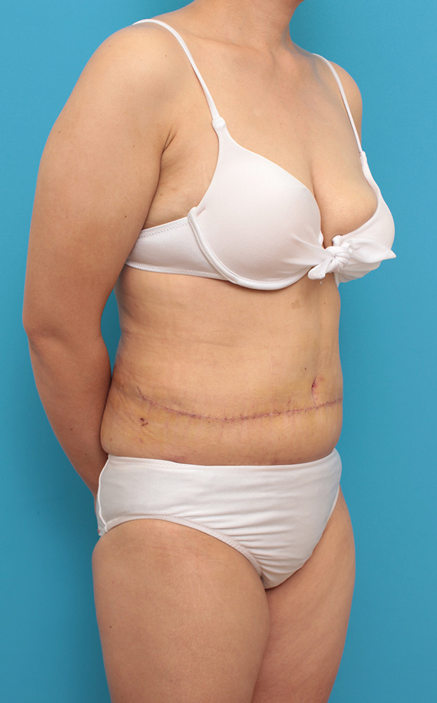 症例写真,お腹のたるみ取り手術（腹部リダクション）の腫れが引いていく症例写真,1週間後,mainpic_hara001h.jpg