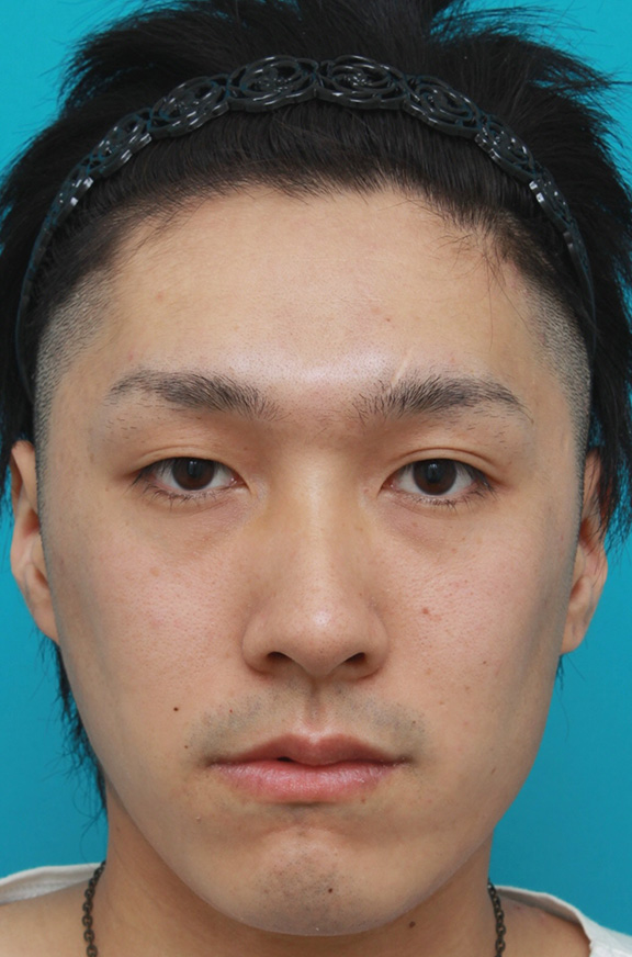 ボツリヌストキシン注射（エラ、プチ小顔術）で小顔になった20代後半の男性患者様の症例写真,Before,ba_botox_puchi026_b01.jpg