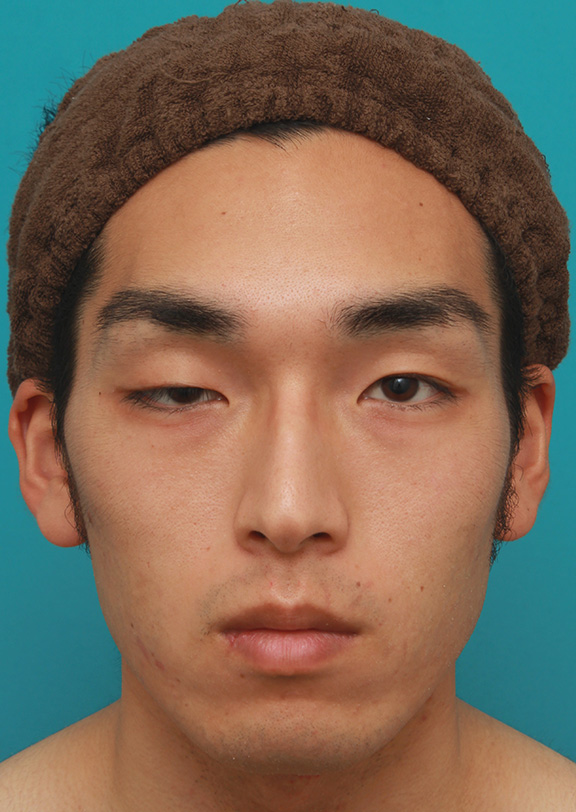 片目の先天性眼瞼下垂を筋膜吊り上げで手術した症例写真,Before,ba_ganken033_b01.jpg