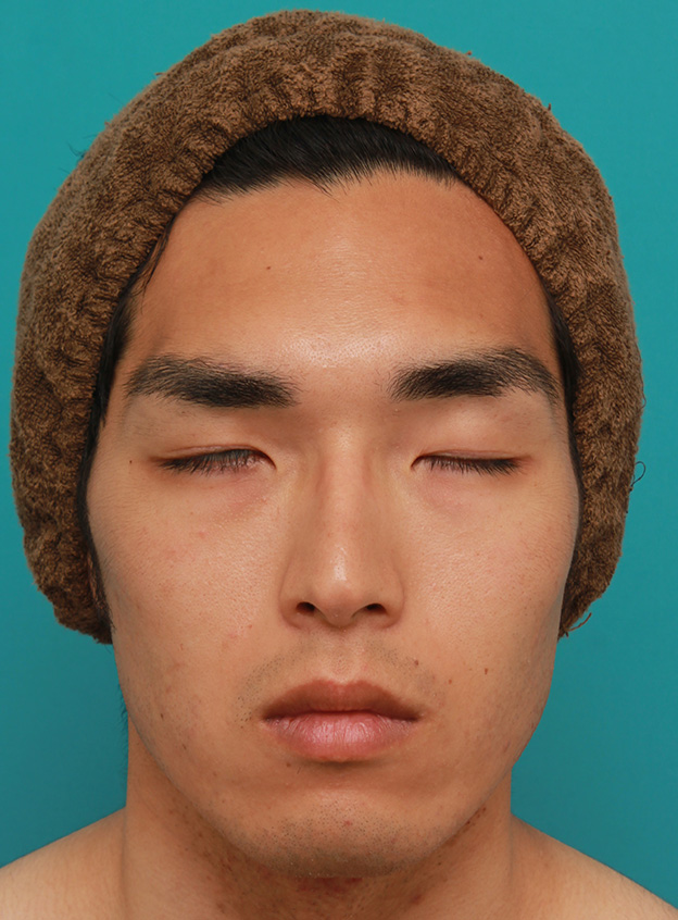 症例写真,片目の先天性眼瞼下垂を筋膜吊り上げで手術した症例写真,6ヶ月後,目を閉じた状態,mainpic_ganken033g.jpg