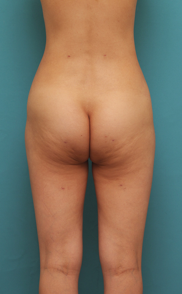 症例写真,痩せている30代前半女性の太ももとお腹周りから脂肪吸引し、バストに脂肪注入した症例写真,1ヶ月後,mainpic_shibokyuin028i.jpg