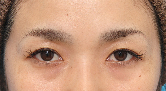 目頭切開で蒙古襞の突っ張りをとり、目を内側に広げた30代女性の症例写真,After（8ヶ月後）,ba_megashira049_a01.jpg
