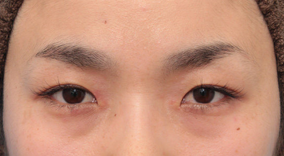 目頭切開で蒙古襞の突っ張りをとり、目を内側に広げた30代女性の症例写真,Before,ba_megashira049_b01.jpg