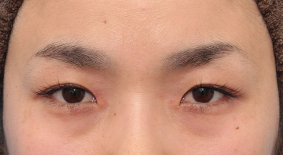 目頭切開で蒙古襞の突っ張りをとり、目を内側に広げた30代女性の症例写真,Before,ba_megashira049_b01.jpg