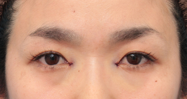 症例写真,目頭切開で蒙古襞の突っ張りをとり、目を内側に広げた30代女性の症例写真,手術直後,mainpic_megashira049b.jpg