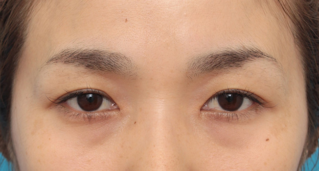 症例写真,目頭切開で蒙古襞の突っ張りをとり、目を内側に広げた30代女性の症例写真,3週間後,mainpic_megashira049d.jpg