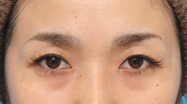 症例写真,目頭切開で蒙古襞の突っ張りをとり、目を内側に広げた30代女性の症例写真,8ヶ月後,mainpic_megashira049e.jpg