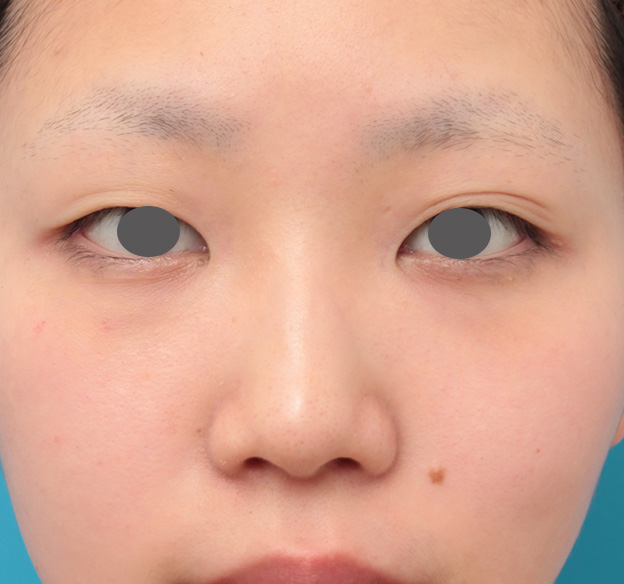症例写真,鼻のシリコンプロテーゼと小鼻（鼻翼）縮小手術を同時に行った症例写真,手術前,mainpic_ryubi1039a.jpg