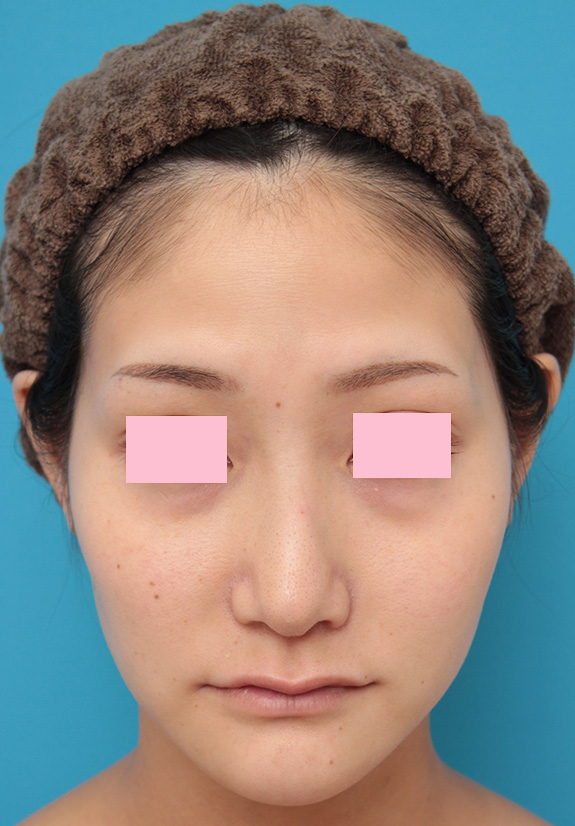 バッカルファット除去,バッカルファット除去手術をした20代女性の症例写真,After（7ヶ月後）,ba_buccalfat013_b01.jpg