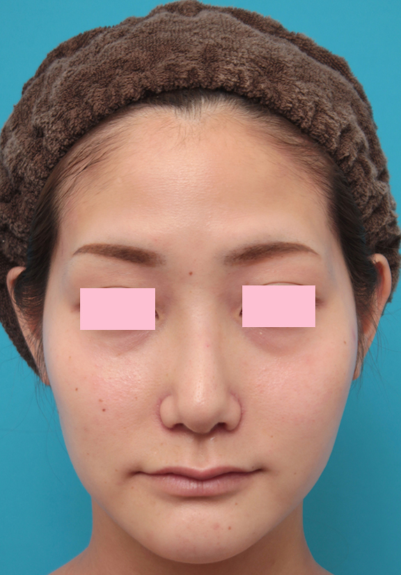 バッカルファット除去,バッカルファット除去手術をした20代女性の症例写真,Before,ba_buccalfat013_b01.jpg