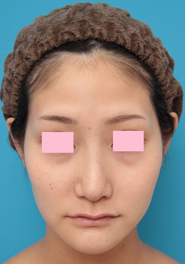 症例写真,バッカルファット除去手術をした20代女性の症例写真,7ヶ月後,mainpic_buccalfat013e.jpg