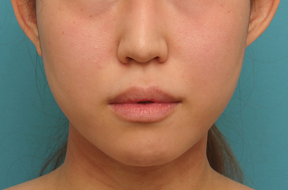 症例写真,ボツリヌストキシン注射（エラ、プチ小顔術）と顎のシリコンプロテーゼで輪郭を綺麗にした症例写真,After,ba_ago013_b01.jpg