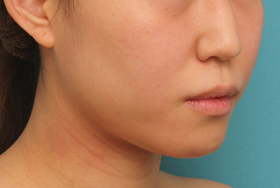 症例写真,ボツリヌストキシン注射（エラ、プチ小顔術）と顎のシリコンプロテーゼで輪郭を綺麗にした症例写真,After,ba_ago013_b02.jpg