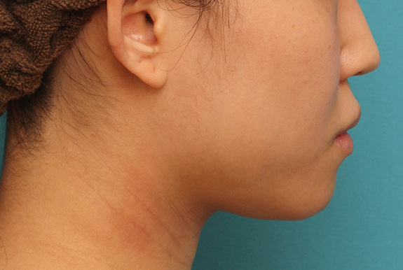 症例写真,ボツリヌストキシン注射（エラ、プチ小顔術）と顎のシリコンプロテーゼで輪郭を綺麗にした症例写真,After,ba_ago013_b03.jpg