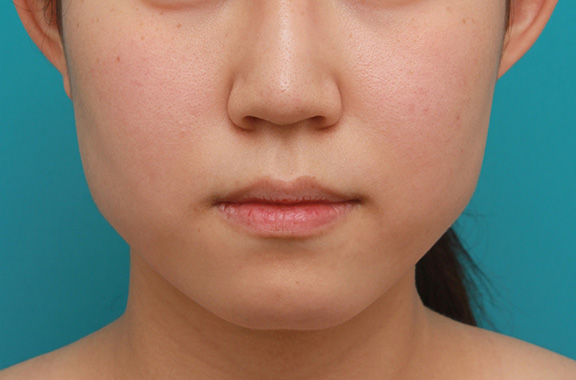 ボツリヌストキシン注射（エラ、プチ小顔術）と顎のシリコンプロテーゼで輪郭を綺麗にした症例写真,Before,ba_ago013_b01.jpg