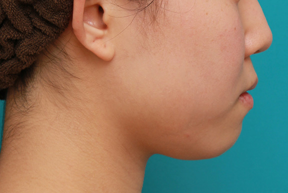 症例写真,ボツリヌストキシン注射（エラ、プチ小顔術）と顎のシリコンプロテーゼで輪郭を綺麗にした症例写真,Before,ba_ago013_b03.jpg