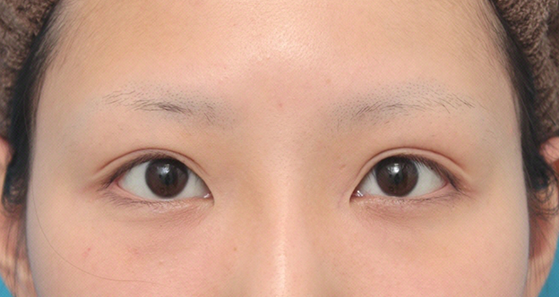 症例写真,眼瞼下垂手術で平行型二重を作った症例写真,6ヶ月後,目を開けた状態,mainpic_ganken034e.jpg