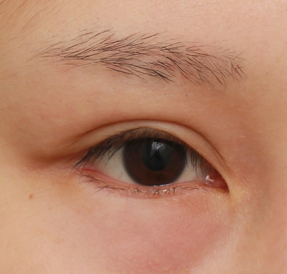症例写真,下まぶたの逆さまつ毛の修正手術の症例写真,After（6ヶ月後）,ba_trichiasis001_b01.jpg