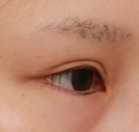 症例写真,下まぶたの逆さまつ毛の修正手術の症例写真,After(6ヶ月後),ba_trichiasis001_b02.jpg