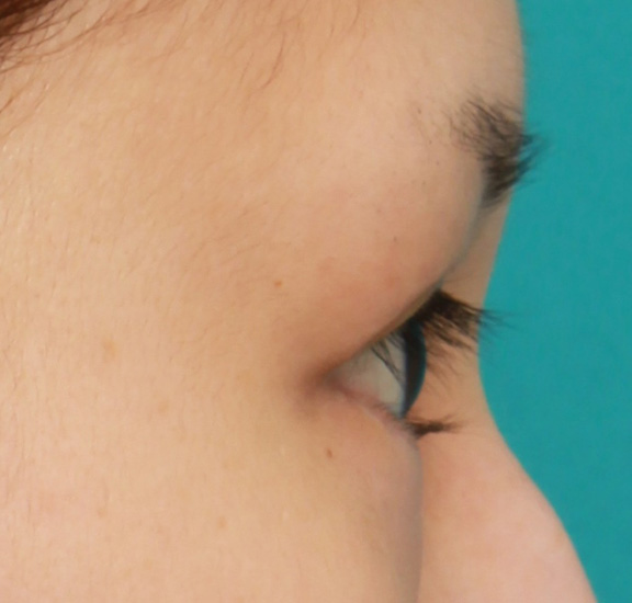 症例写真,下まぶたの逆さまつ毛の修正手術の症例写真,After(6ヶ月後),ba_trichiasis001_b03.jpg