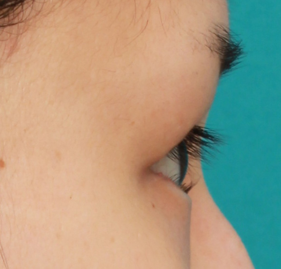 症例写真,下まぶたの逆さまつ毛の修正手術の症例写真,Before,ba_trichiasis001_b03.jpg
