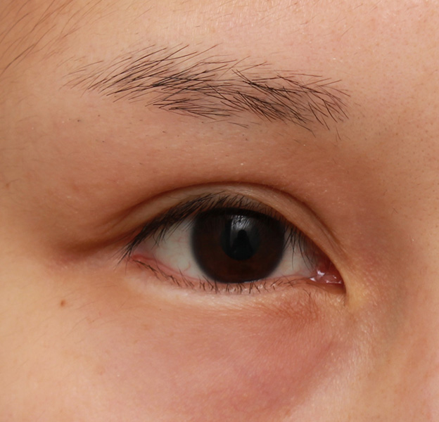症例写真,下まぶたの逆さまつ毛の修正手術の症例写真,手術前,mainpic_trichiasis001a.jpg