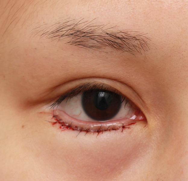 症例写真,下まぶたの逆さまつ毛の修正手術の症例写真,手術直後,mainpic_trichiasis001b.jpg