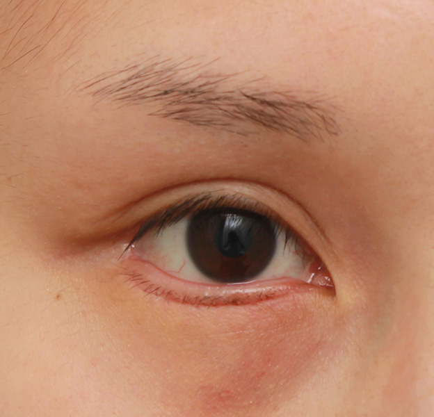 症例写真,下まぶたの逆さまつ毛の修正手術の症例写真,1週間後,mainpic_trichiasis001c.jpg