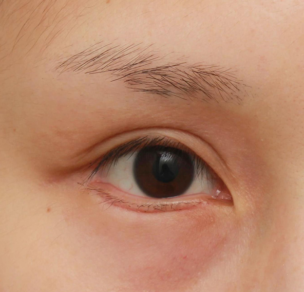 症例写真,下まぶたの逆さまつ毛の修正手術の症例写真,3週間後,mainpic_trichiasis001d.jpg