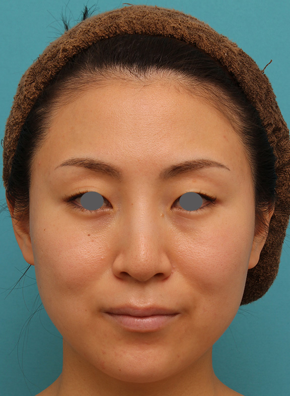 下がっている口角を上げるボツリヌストキシン注射の症例写真,After（1ヶ月後）,ba_lipsup_botox005_a01.jpg