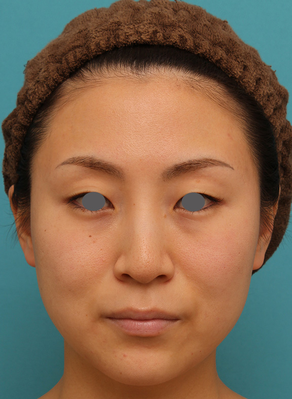下がっている口角を上げるボツリヌストキシン注射の症例写真,Before,ba_lipsup_botox005_b01.jpg