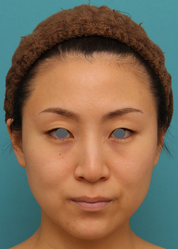 症例写真,下がっている口角を上げるボツリヌストキシン注射の症例写真,1週間後,mainpic_lipsup_botox005c.jpg