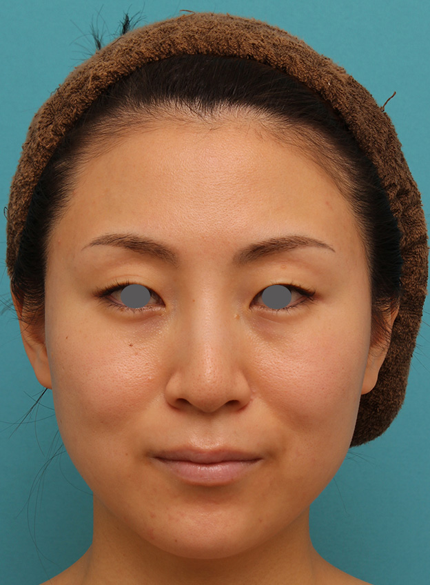 症例写真,下がっている口角を上げるボツリヌストキシン注射の症例写真,1ヶ月後,mainpic_lipsup_botox005d.jpg