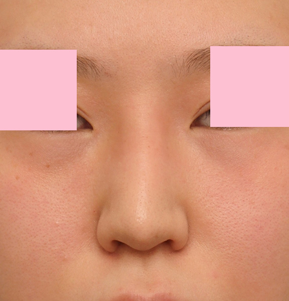小鼻（鼻翼）縮小手術と鼻先の耳介軟骨移植を同時に行った20代女性の症例写真,After,ba_jikai035_a01.jpg