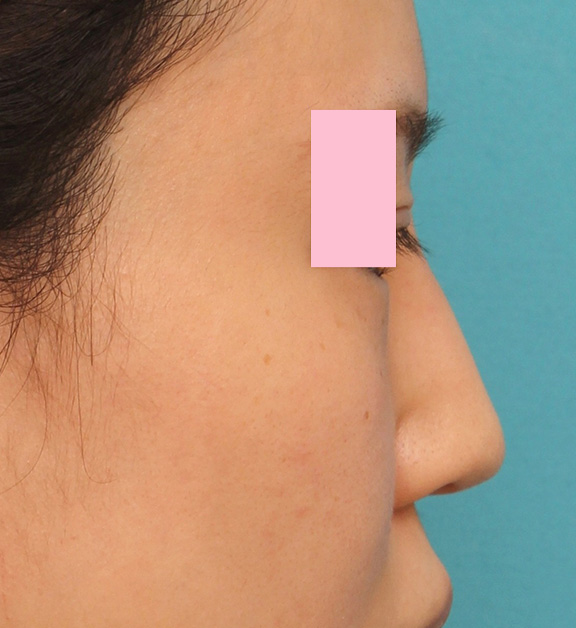 症例写真,小鼻（鼻翼）縮小手術と鼻先の耳介軟骨移植を同時に行った20代女性の症例写真,After,ba_jikai035_b03.jpg