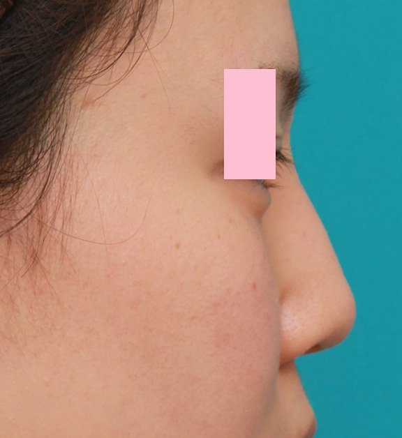 症例写真,小鼻（鼻翼）縮小手術と鼻先の耳介軟骨移植を同時に行った20代女性の症例写真,Before,ba_jikai035_b03.jpg