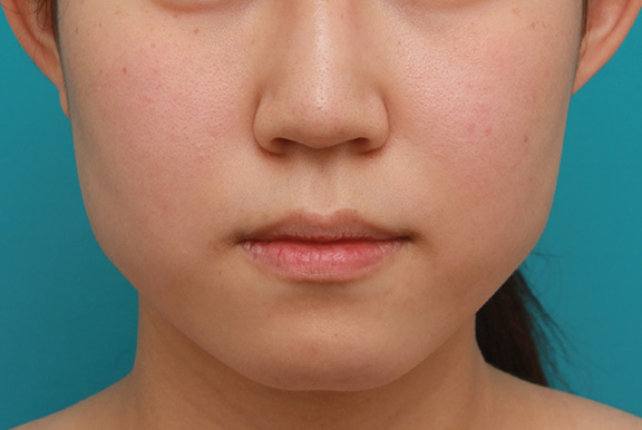 ヒアルロン酸注射でぷっくり厚いセクシーな唇になった20代女性の症例写真,Before,ba_atsuku014_b01.jpg