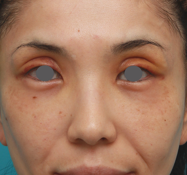 症例写真,患者様の希望で眉間から鼻根部にかけてヒアルロン酸を注射し、ギリシャ人のようになった症例写真,注射前,mainpic_ryubi2028a.jpg