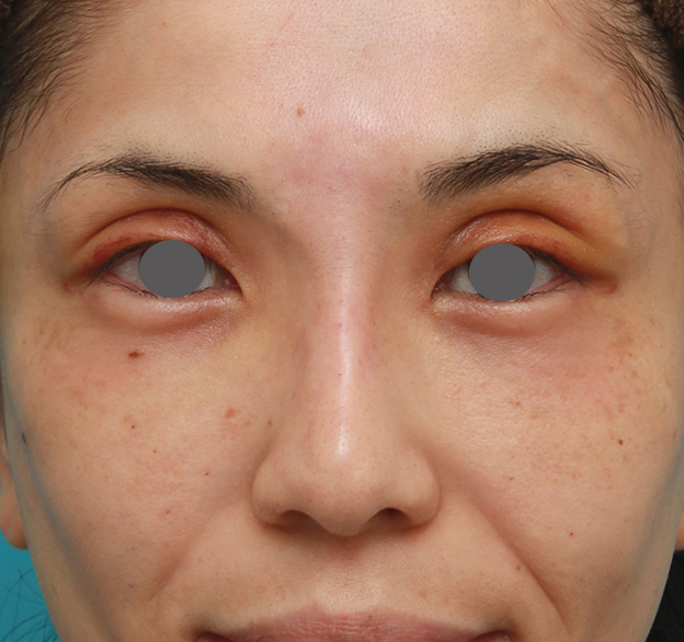 症例写真,患者様の希望で眉間から鼻根部にかけてヒアルロン酸を注射し、ギリシャ人のようになった症例写真,注射直後,mainpic_ryubi2028b.jpg