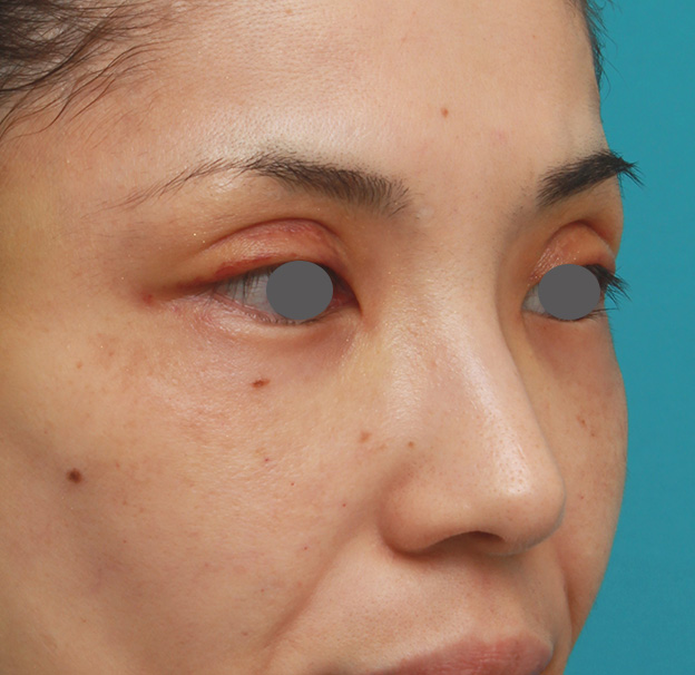 症例写真,患者様の希望で眉間から鼻根部にかけてヒアルロン酸を注射し、ギリシャ人のようになった症例写真,注射前,mainpic_ryubi2028d.jpg