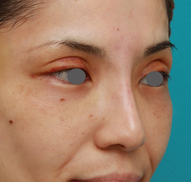 症例写真,患者様の希望で眉間から鼻根部にかけてヒアルロン酸を注射し、ギリシャ人のようになった症例写真,注射直後,mainpic_ryubi2028e.jpg