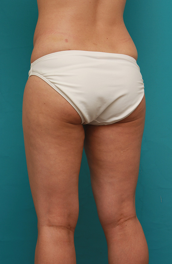 症例写真,イタリアン・メソシェイプ（イタリアンメソセラピー）・脂肪溶解注射で太もも全体を一回り細くした40代女性の症例写真,After（6回注射後2ヶ月）,ba_meso038_b04.jpg