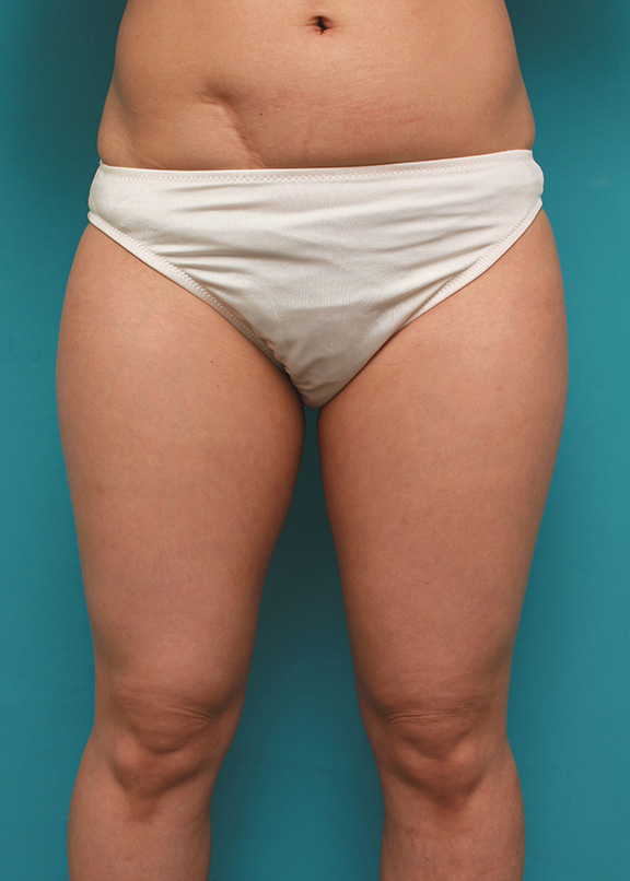 症例写真,イタリアン・メソシェイプ（イタリアンメソセラピー）・脂肪溶解注射で太もも全体を一回り細くした40代女性の症例写真,Before,ba_meso038_b01.jpg
