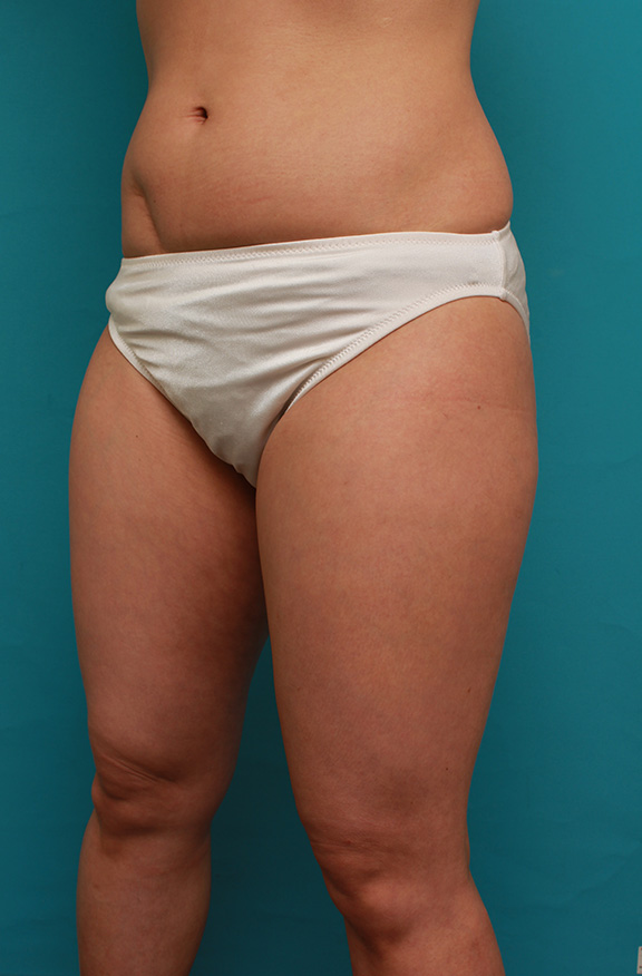 症例写真,イタリアン・メソシェイプ（イタリアンメソセラピー）・脂肪溶解注射で太もも全体を一回り細くした40代女性の症例写真,Before,ba_meso038_b02.jpg
